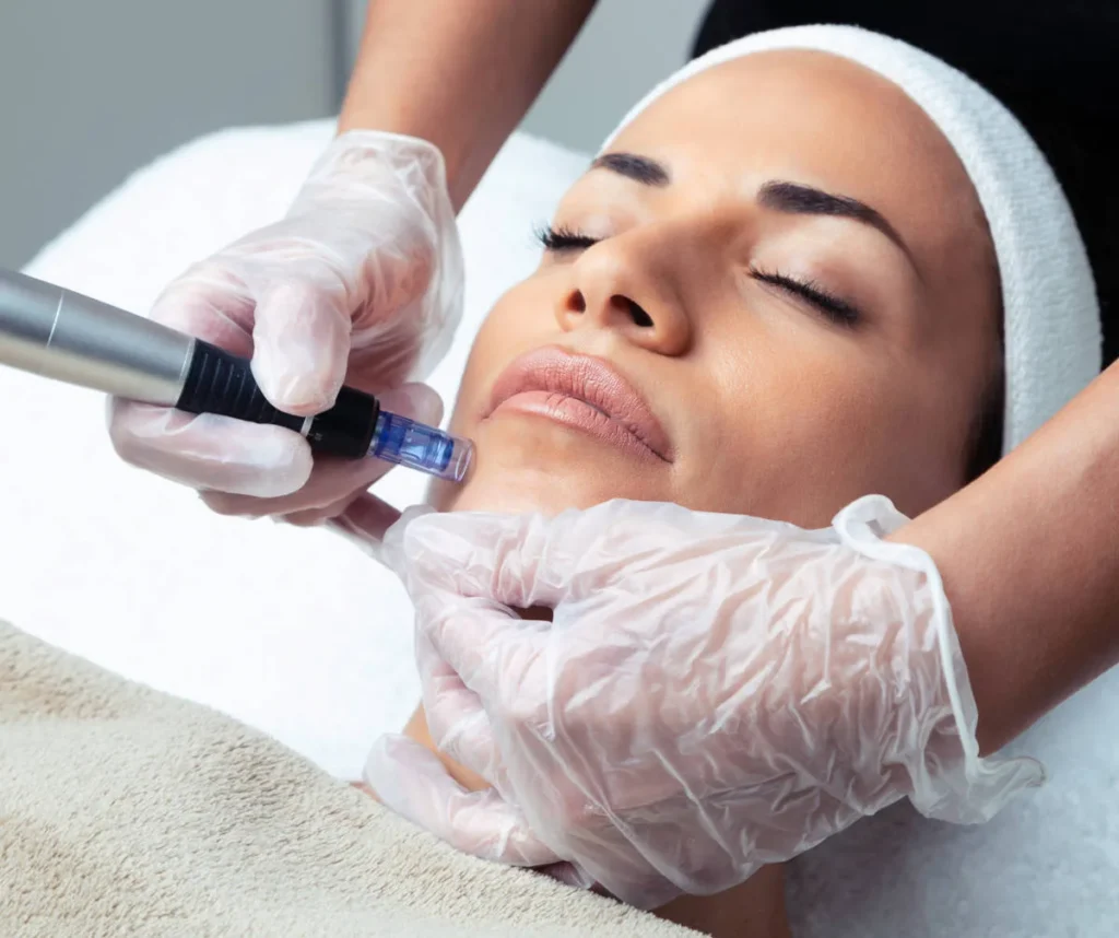 SkinPen Microneedling