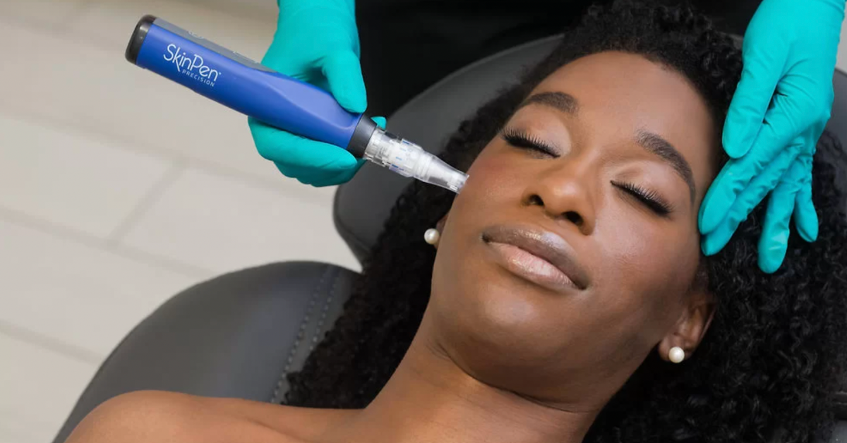 How SkinPen Microneedling Improves Acne Scars, Texture, and Fine Lines
